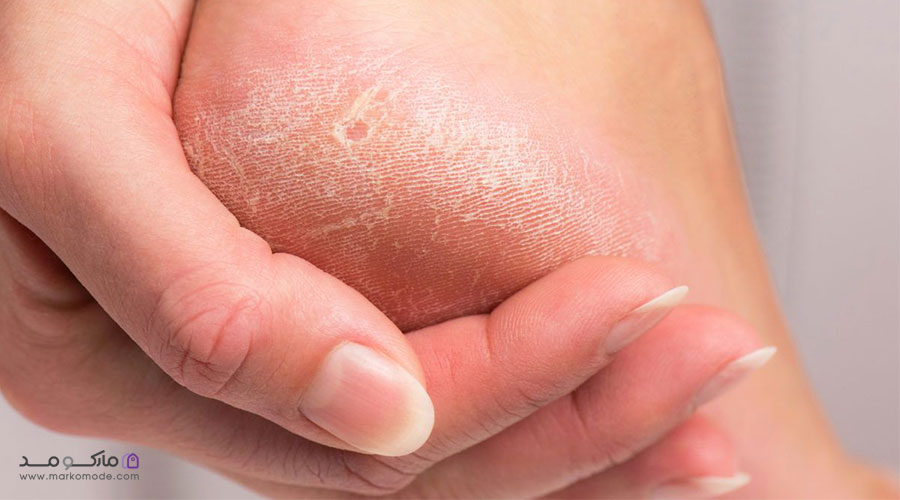 علل و عوامل خطرناک پینه پا